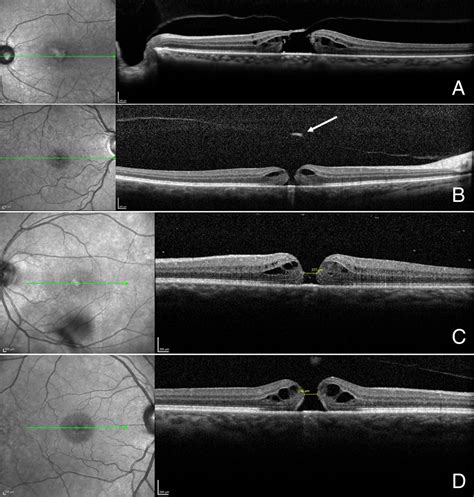 thickness measurement of retinal layers|full thickness retinal hole.